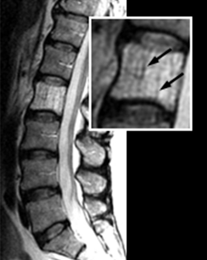 Vertebral Hemangioma Radsource