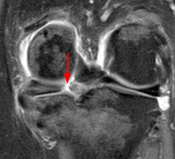 Meniscal Tear Patterns Radsource
