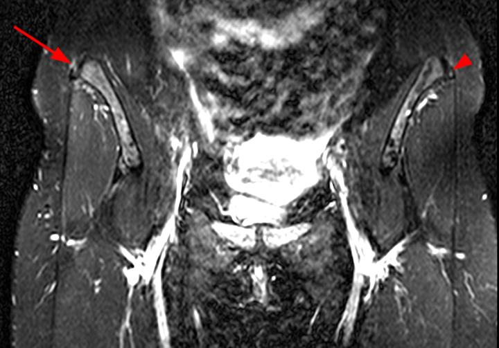 Proximal Iliotibial Band Syndrome Radsource