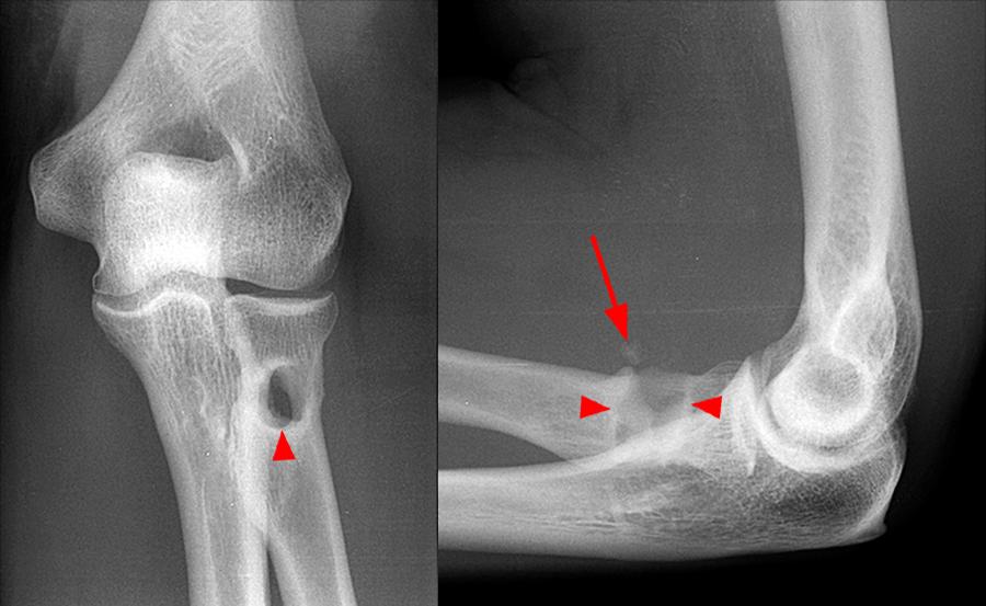 Distal Biceps Tendon Rupture Elbow Radsource
