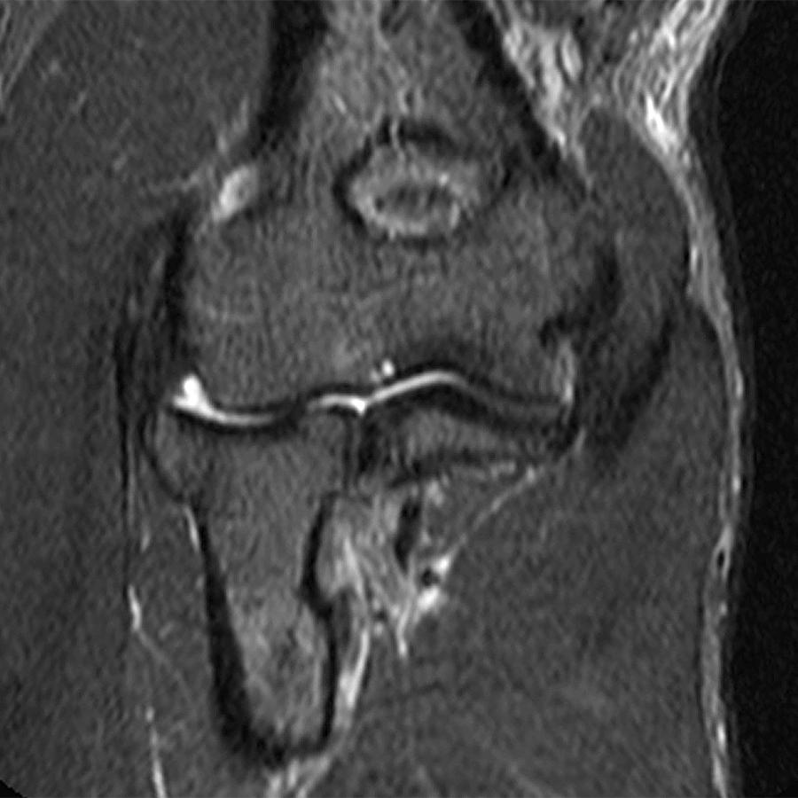Distal Biceps Tendon Rupture Elbow Radsource