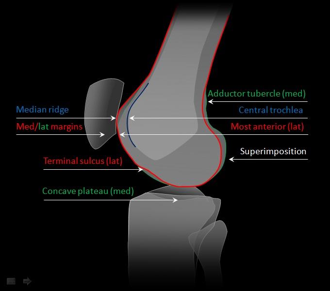 Trochlear Dysplasia Radsource
