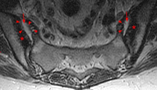 Ankylosing Spondylitis Radsource