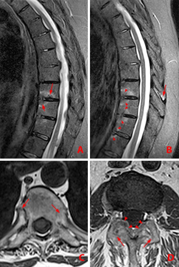 Ankylosing Spondylitis Radsource