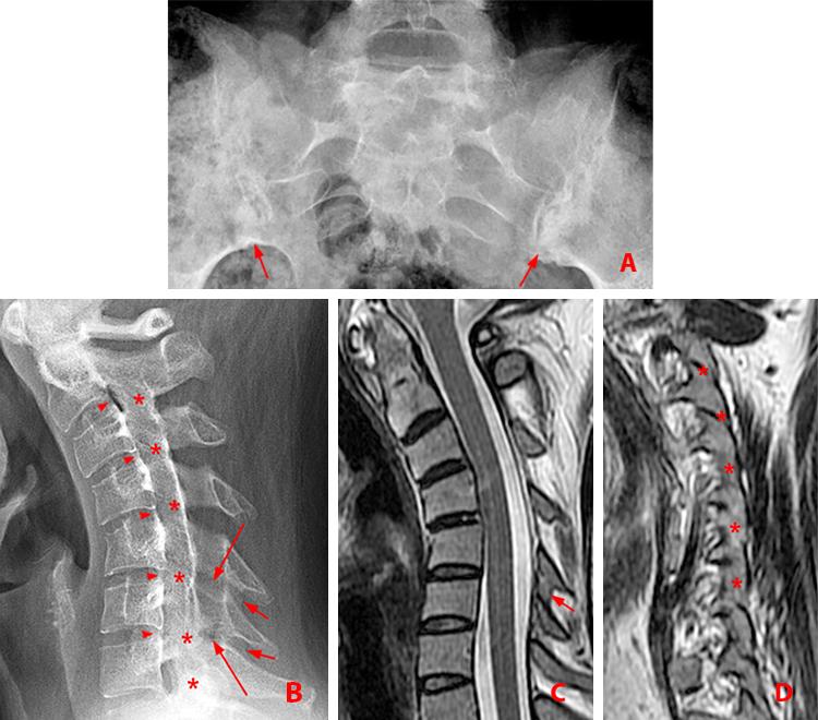 Ankylosing Spondylitis Radsource