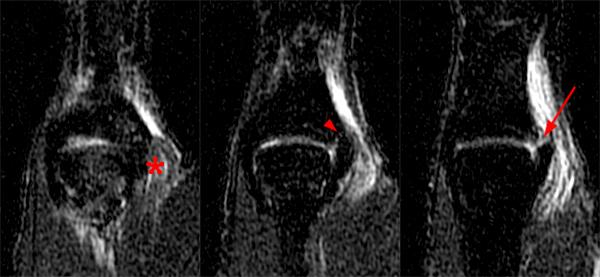 Ulnar Collateral Ligament Tears of the Thumb Radsource