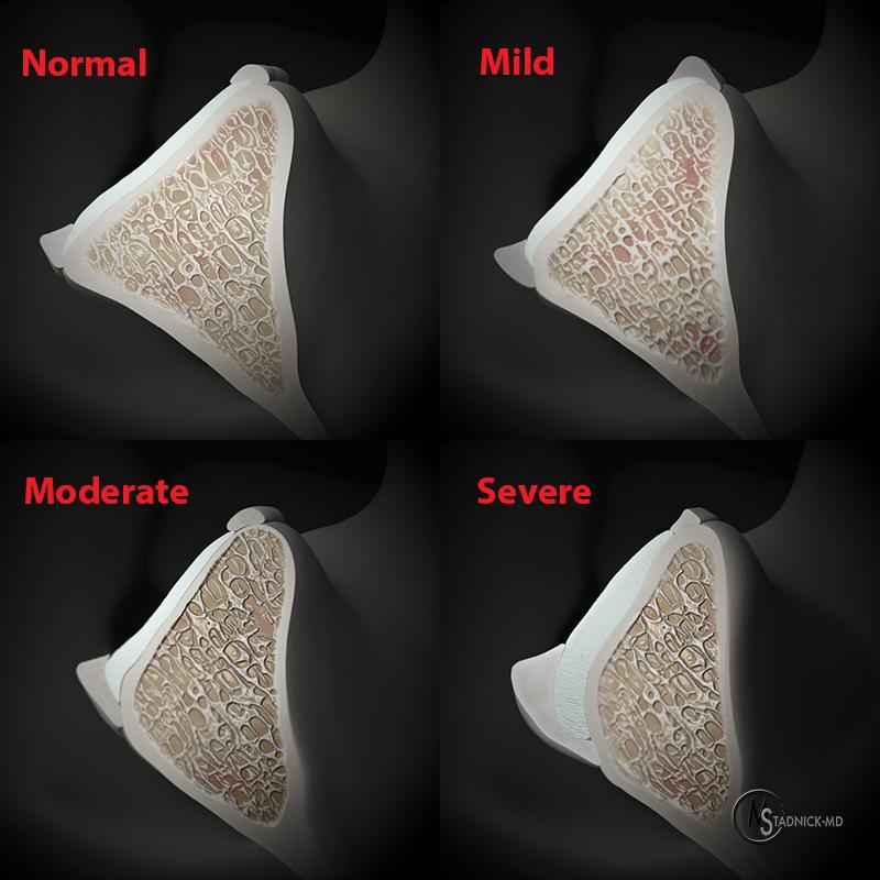 Posterior Glenohumeral Instability Radsource