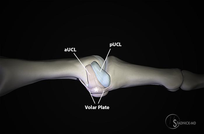 Ulnar Collateral Ligament Tears of the Thumb Radsource