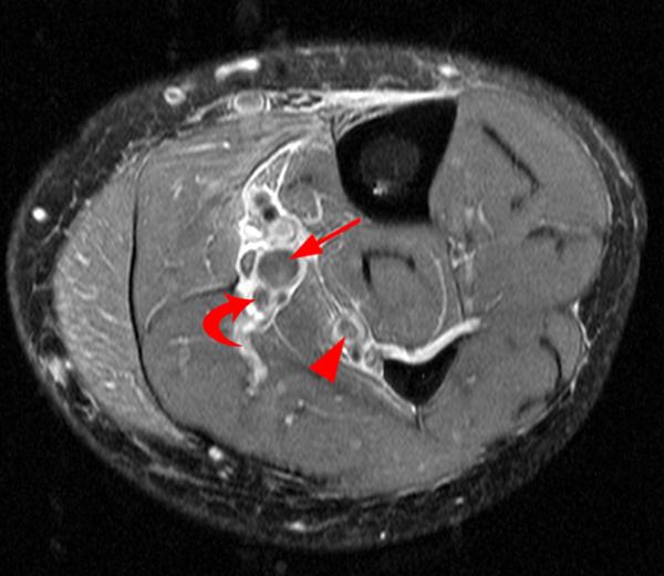 Deep Venous Thrombosis