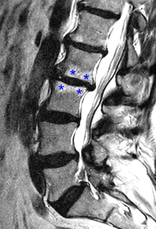 Vertebral Endplate Changes