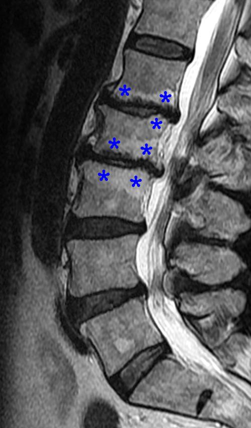 Vertebral Endplate Changes