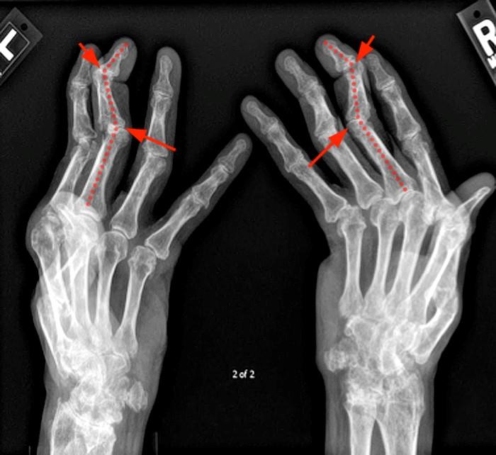 MR Imaging of Rheumatoid Arthritis Radsource