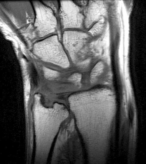 MR Imaging of Rheumatoid Arthritis Radsource