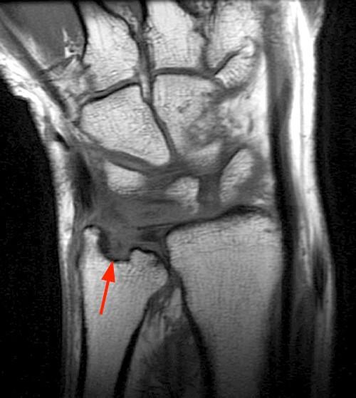 MR Imaging of Rheumatoid Arthritis Radsource