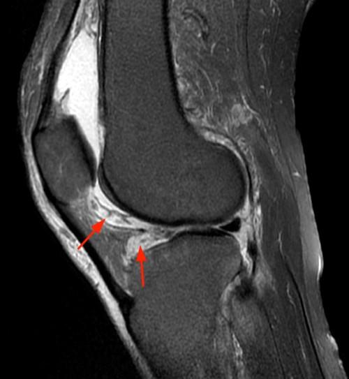 Rheumatoid Arthritis Knee Mri