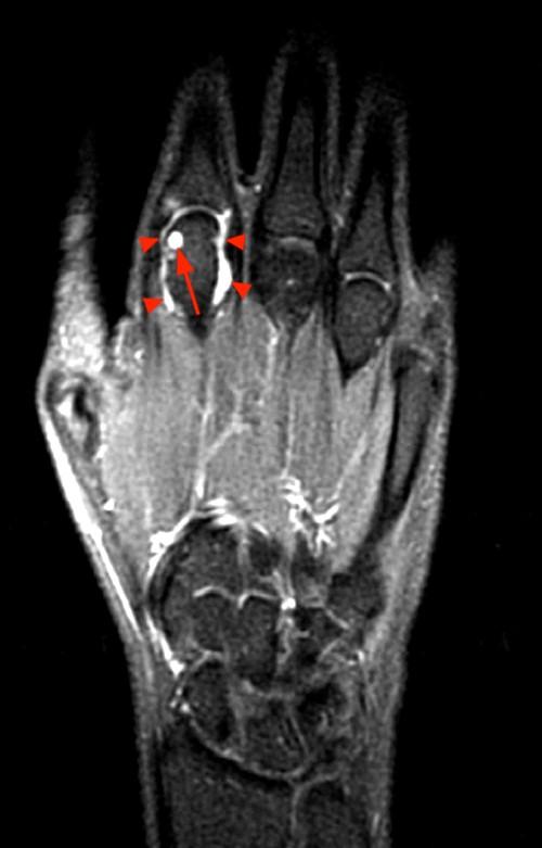 MR Imaging of Rheumatoid Arthritis Radsource
