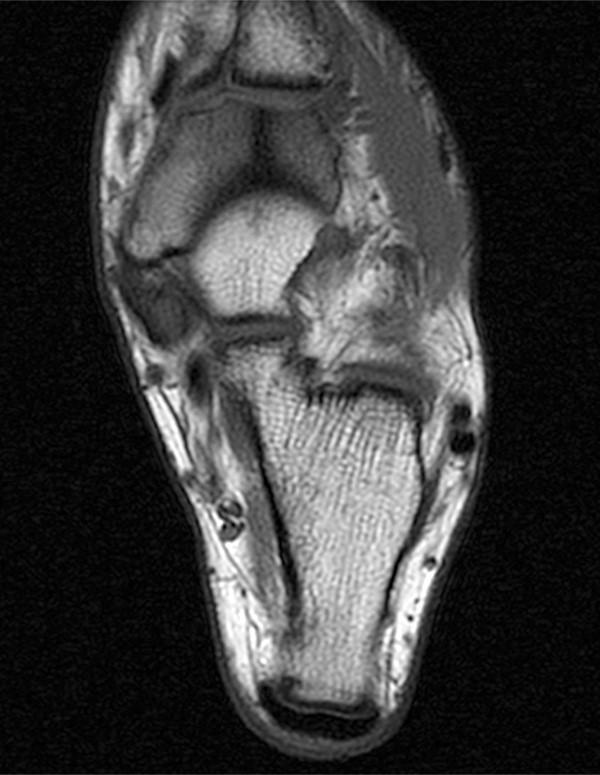 Stress fractures in the foot and ankle