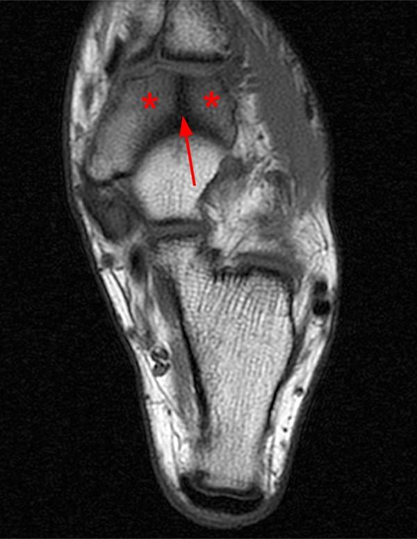 Stress fractures in the foot and ankle