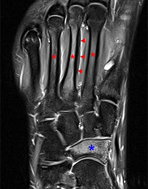 Stress fractures in the foot and ankle