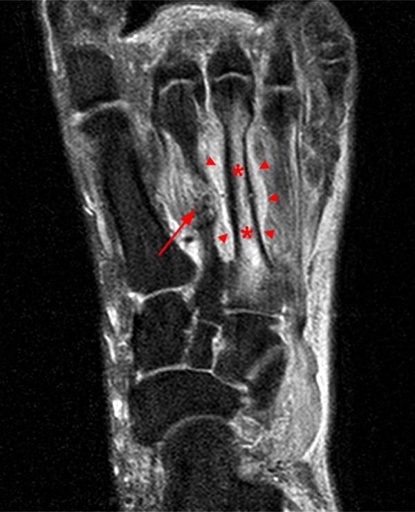 Xray Of Foot Stress Fracture