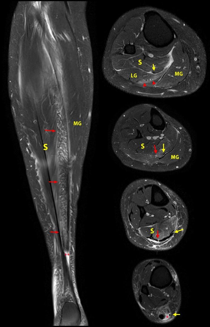 Calf Injury Anatomy at Christina Landis blog