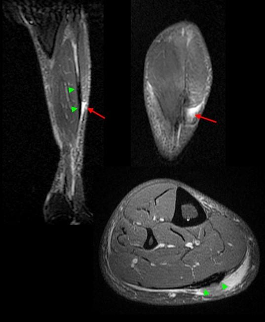 Not the Plantaris Keys to Better Diagnosis of Calf Strain Injuries
