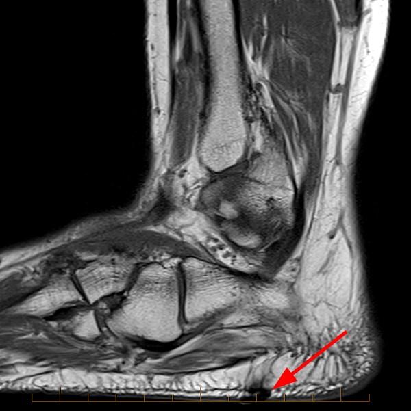 Foreign Body Imaging with MRI Radsource