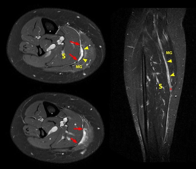 Not the Plantaris Keys to Better Diagnosis of Calf Strain Injuries