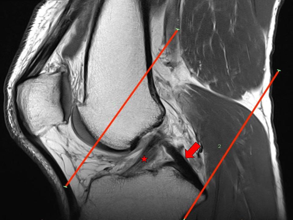 Atypical Scan Angles in Musculoskeletal MRI Radsource