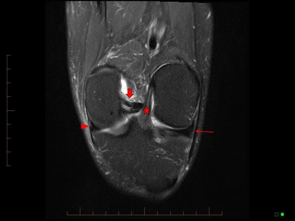 Atypical Scan Angles in Musculoskeletal MRI Radsource