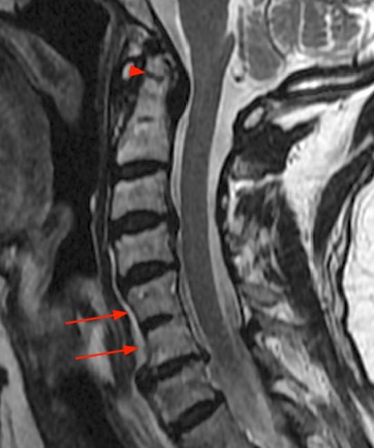 Klippel Feil Syndrome Radsource