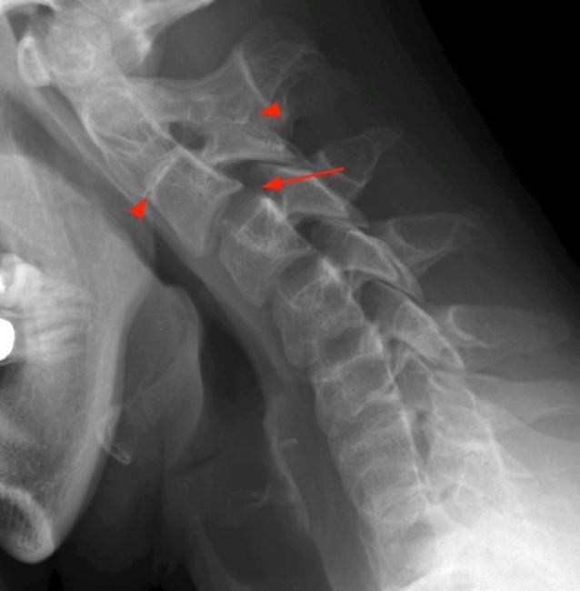 Klippel Feil Syndrome Radsource