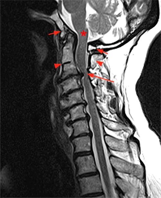 Klippel Feil Syndrome Radsource