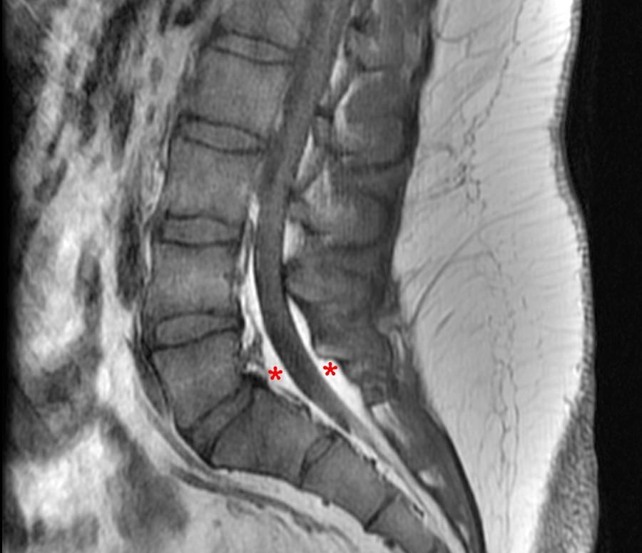 Spinal Epidural Lipomatosis with Review of Visceral Fat Deposition in