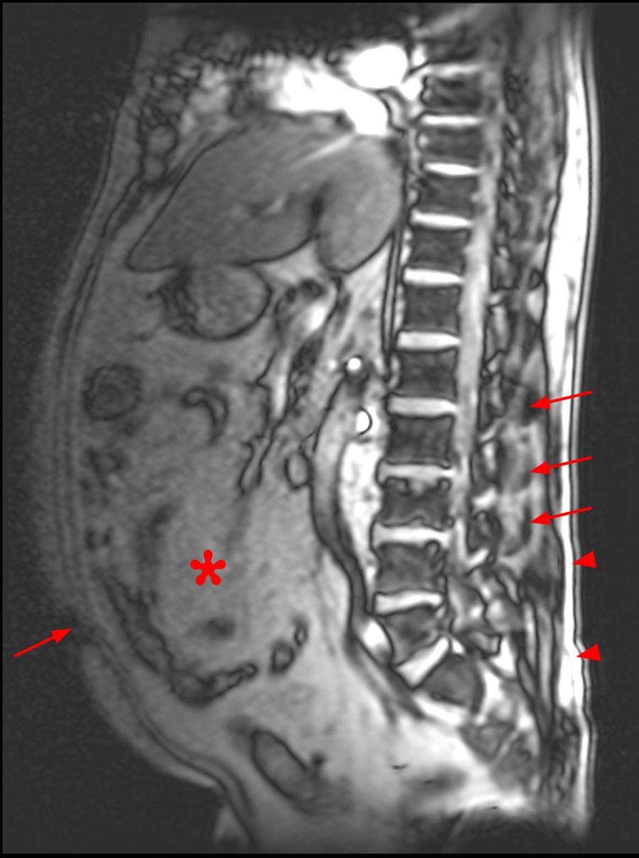 Spinal Epidural Lipomatosis with Review of Visceral Fat