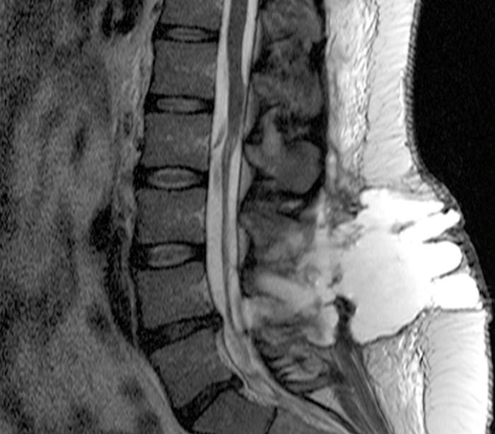 Pseudomeningocele Radsource