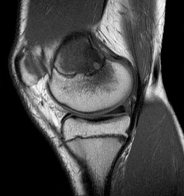Osteomyelitis Radsource
