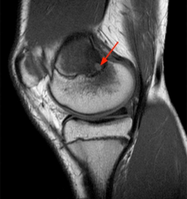 Osteomyelitis Radsource