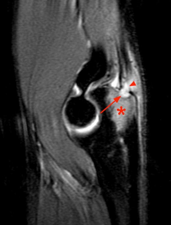 Osteomyelitis Radsource
