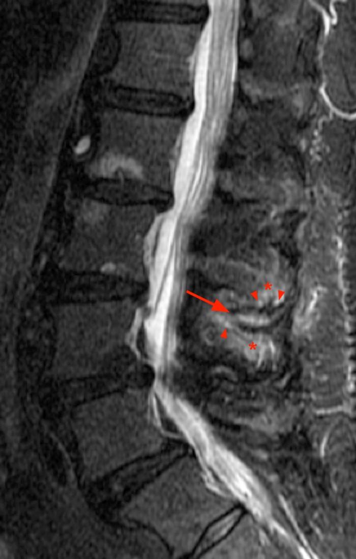 Baastrup’s Disease