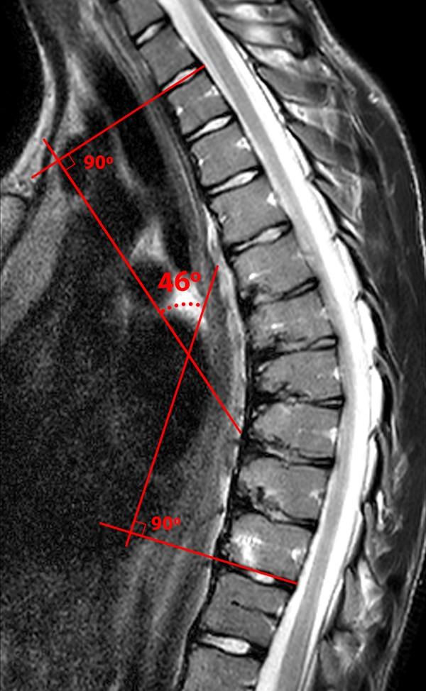 Scheuermann’s Disease Radsource