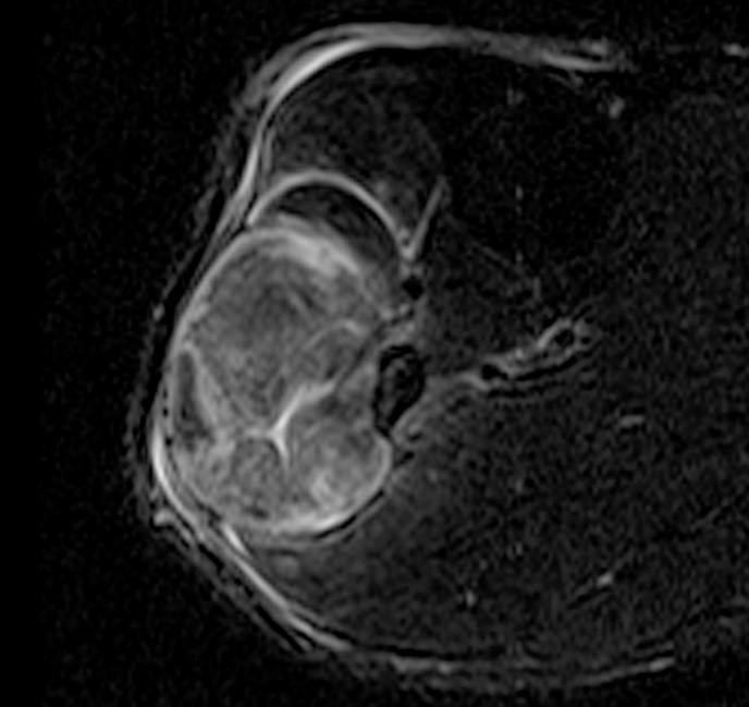 Compartment Syndrome of the Leg Radsource