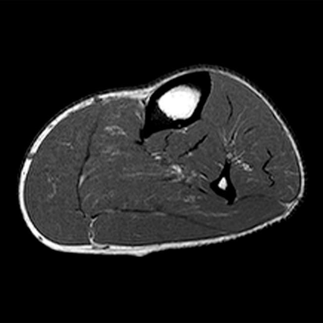 Compartment Syndrome Leg Ultrasound