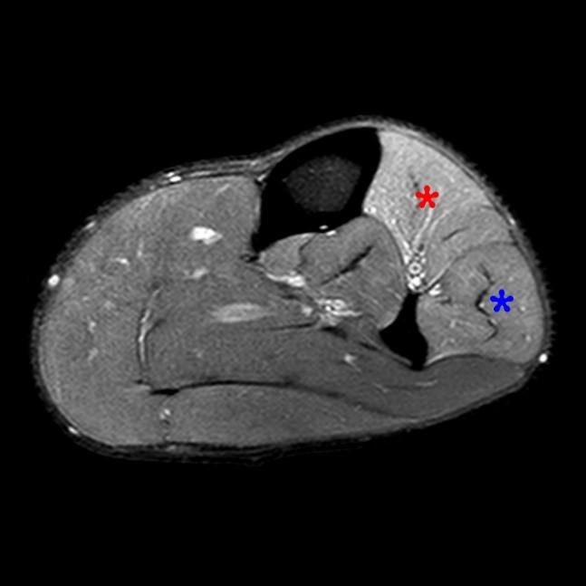 Compartment Syndrome of the Leg Radsource
