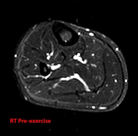 Compartment Syndrome of the Leg Radsource