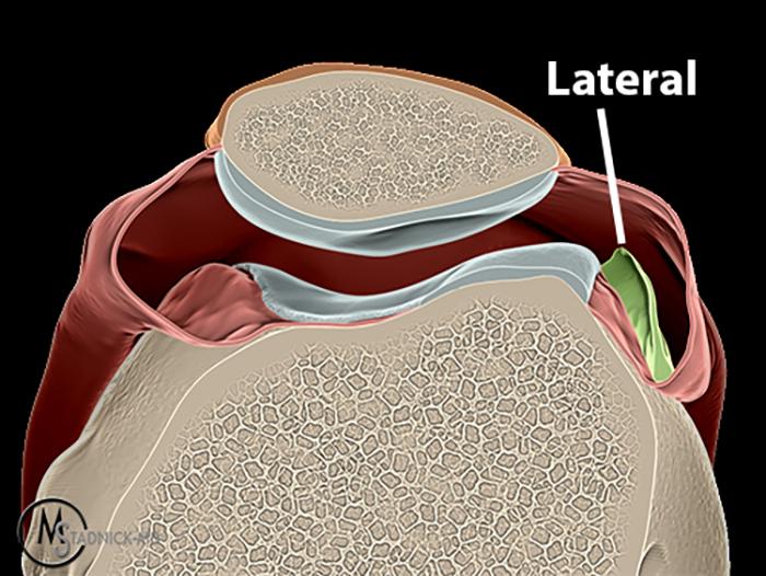 Synovial Plicae of the Knee Radsource