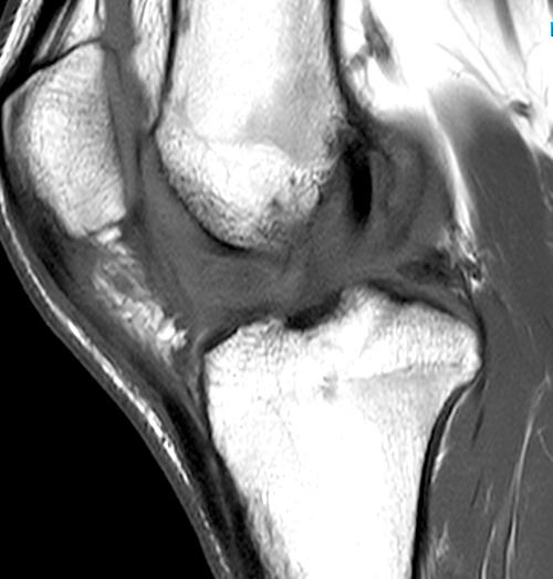 Arthrofibrosis of the Knee Radsource