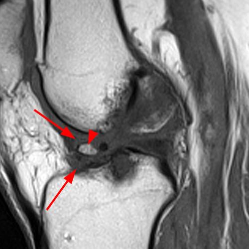 Arthrofibrosis of the Knee Radsource