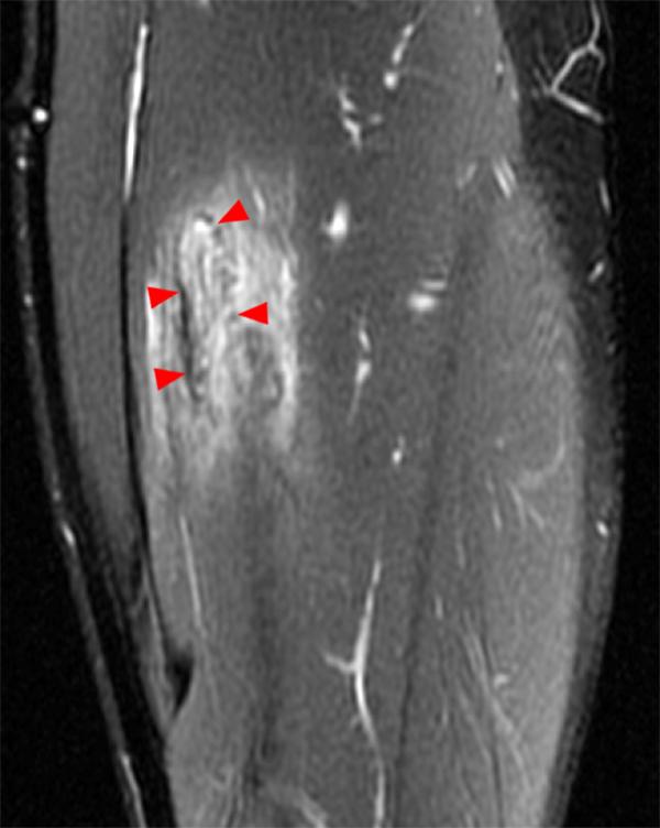 Myositis Ossificans Radsource