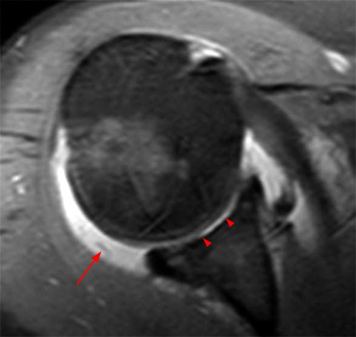 Chondrolysis of the Glenohumeral Joint Radsource